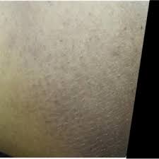 The inner thighs are a sensitive area. Pdf Frictional Melanosis Of Rubbing Thighs In Iraqi Patients