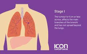A diagnosis of stage 1 lung cancer means that a tumor is discovered, but it is still localized within the lungs. Lung Cancer Types Stages Icon Cancer Centre Singapore