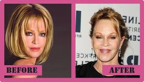 Melanie's face looking awful which indicates that her surgery has gone wrong and ruined her face. Melanie Griffith Plastic Surgery The Flaws And All