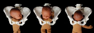 Image result for Breech Delivery