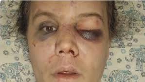 IN CUSTODY: The 4th suspect is in custody. A 25-year-old suspect  surrendered late Thursday at the police department in connection with the  hate crime assault