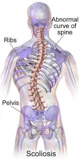 Pin On Scoliosis