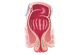 Image result for Rectal prolapse