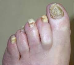 Las uñas acrílicas para pies no son algo que solo te puedes encontrar en tu vecina o amiga del trabajo. Infecciones Por Hongos En Las Unas De Las Manos Y De Los Pies Ecured