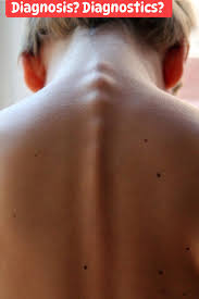 Image result for Webbed Neck