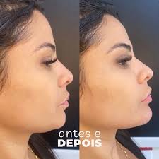 ✨ Preenchimento de mento (queixo) com 1mL de ácido hialurônico! Com 1mL  conseguimos preencher a região deixando o perfil da nossa linda paciente  mais harmônico, disfarçando a região da papada, evidenciando o