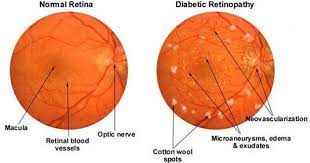 Diabetic Retinopathy Diabetic Retinopathy Diabetes Diabetic Eye Problems