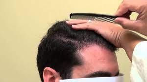 Fue Before And After Hair Transplant Surgery San Francisco Dr Diep Www Mhtaclinic Com Hair Transplant Surgery Hair Transplant Bald Head