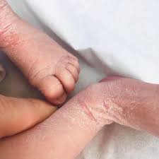 Por Que Los Recien Nacidos Tienen Los Pies Tan Secos