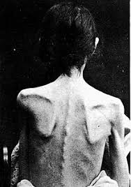Lead study author cynthia bulik, ph.d., director of the center of excellence for eating disorders at the university of north carolina, chapel hill, found that 13 percent of american women 50 or older experience symptoms of an eating disorder; Anorexia Nervosa Wikipedia