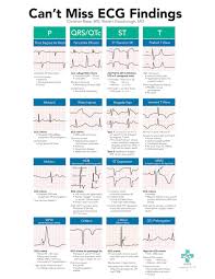 A High Yield On Shift Resource To Help Emergency Department Providers Spot Subtle High Risk Ecg In 2020 Emergency Nursing Cardiology Nursing Nursing School Survival