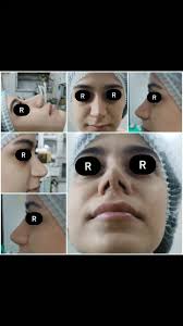 ترميم الأنف بعد عمل جراحي سابق👃🪄, #تجميل_انف #rhinoplasty #nosesurgery  #facialsurgery #cosmeticsurgery #plasticsurgery #nosejob #beautyenhancement  #facialreconstruction #nosereshaping ...