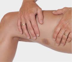 Image result for Contusion