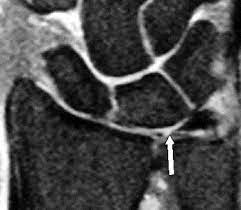 The tfcc can become torn with a fall on an outstretched hand, other trauma, or just wear and tear. Tfcc Injury Hand Orthobullets