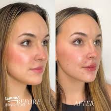 Experience Filler with Me at Radiant Wellness 💉