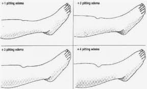 1 2 3 Edema Rating Scale General Nursing Allnurses