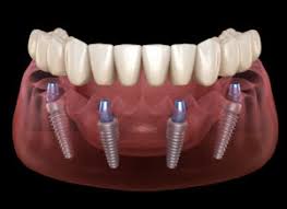 Some products can be significantly higher, even as much as $6,000 or more per implant (not including: Implant Supported Dentures