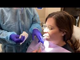 Fluoride Tray Method