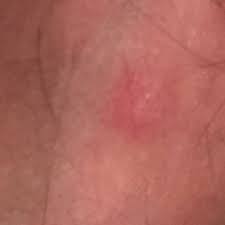 Warum pickel unter der haut entstehen? Krebs Unter Der Haut Oder Einfach Nur Eine Art Pickel Gefahrlich Spital