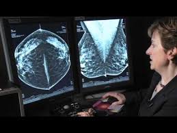 What does breast cancer look like on a mammogram? Innovations In Breast Cancer Detection 3d Mammography Youtube