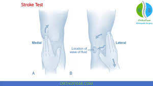 Image result for Knee Bulge Sign