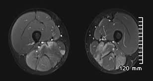 Image result for Myopathy