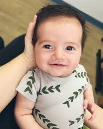 Image result for Cleft Lip