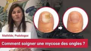 Lorsque la barrière physique que constitue la peau est lésée ou fragilisée,. Debarassez Vous Definitivement De Votre Mycose D Ongle