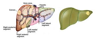 The liver is your largest internal organ. Liver Tumors In Infancy And Children Intechopen