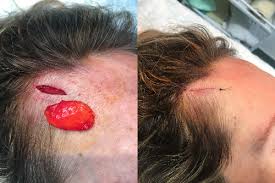 Lipoma and cyst removal