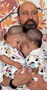 Conjoined twins born with fused brain tissue separated after risky surgery