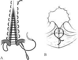 In the case where it is necessary to provide some wrenching of the edges of the wound, a horizontal matt suture approaches. Schematics Of The Suture Technique The Vaginal Roof Was Closed With Download Scientific Diagram