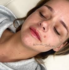 BETH MELVILLE AESTHETICS (@bethmelville_aesthetics) • Instagram photos and  videos