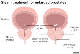 Prostatitis or bph (benign prostatic hypertrophy, also known as enlargement of the prostate) are benign diseases but. Steam Treatment For Big Prostates Approved On Nhs Bbc News