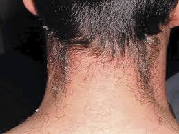 Clips from exploring current practices in cosmetic. A Young Rash On Old Shoulders Scarlet Fever In An Adult Male The Lancet Infectious Diseases