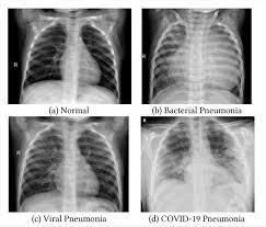 Primary lung tumors, also known as pulmonary tumors, are frequently malignant and require surgery to remove both the growth and a significant portion of the lung. Transfer Learning Exploits Chest Xray To Diagnose Covid 19 Pneumonia