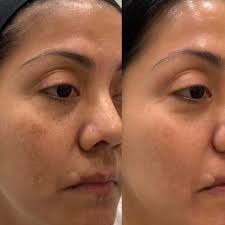 Michelle Huseman RN (@michellehuseman_aestheticsrn) • Instagram photos and  videos