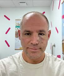 Plastic Surg€ry is successful. Thank you God! And thank you all for the  support, encouragement and prayers! Now healing begins. Btw, the cancer  spot was a size of a penny and also