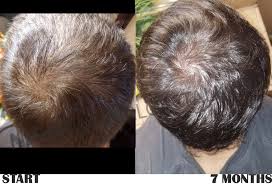 Ketoconazole is believed to work by Long Time Member Finds Some Success 7 Months On Finasteride Nizoral Hairlosstalk Forums