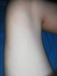 Er zeigt die entzündung einer lymphbahn an, die zu einer sepsis führen kann. Dunner Roter Strich Auf Der Haut Gesundheit Und Medizin Korper Hautprobleme