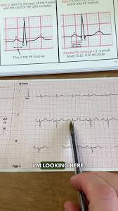 Image result for PR Interval