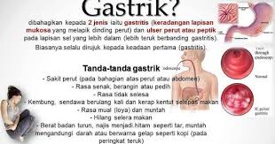 Check spelling or type a new query. Tanda Tanda Sakit Gastrik Dan Rawatan Terbaik Pengedar Shaklee Rawang
