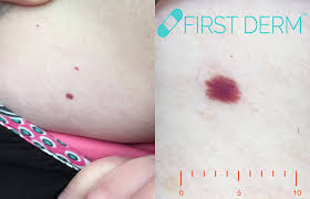 Getting a diagnosis and treatment plan from a healthcare professional helps ensure that a person can treat any problems early and avoid complications, such as infections. Red Spots On Skin Pictures Causes Treatment Online Dermatology