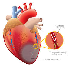 Image result for heart attack