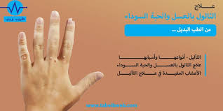 علاج الثالول بالعسل والحبة السوداء طبيب ويب