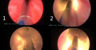Adenome Prostate Vaporisation Laser Greenlight Hupertan Bichat Idee Deco