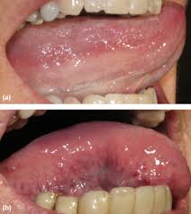 Image result for Sublingual Varices