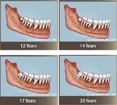How much does wisdom teeth removal cost? Wisdom Teeth Extraction Quotes Cost To Remove Wisdom Tooth English Forum Switzerland Dogtrainingobedienceschool Com