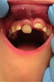Image result for Tooth Luxation