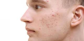 Que Es El Acne Sintomas Causas Y Como Tratar La Enfermedad